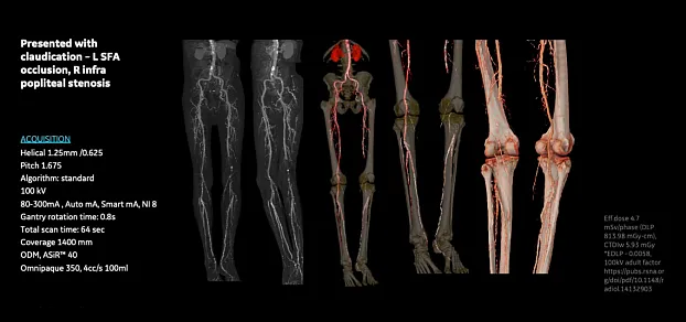 КТ-ангиография нижних конечностей