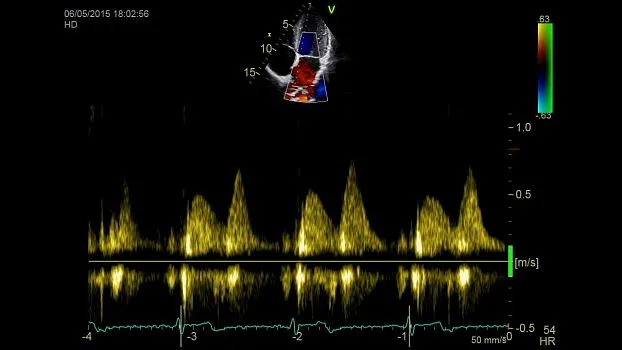Клинические изображения GE HealthCare Vivid iQ УЗИ аппарат портативный